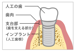 インプラントとは?